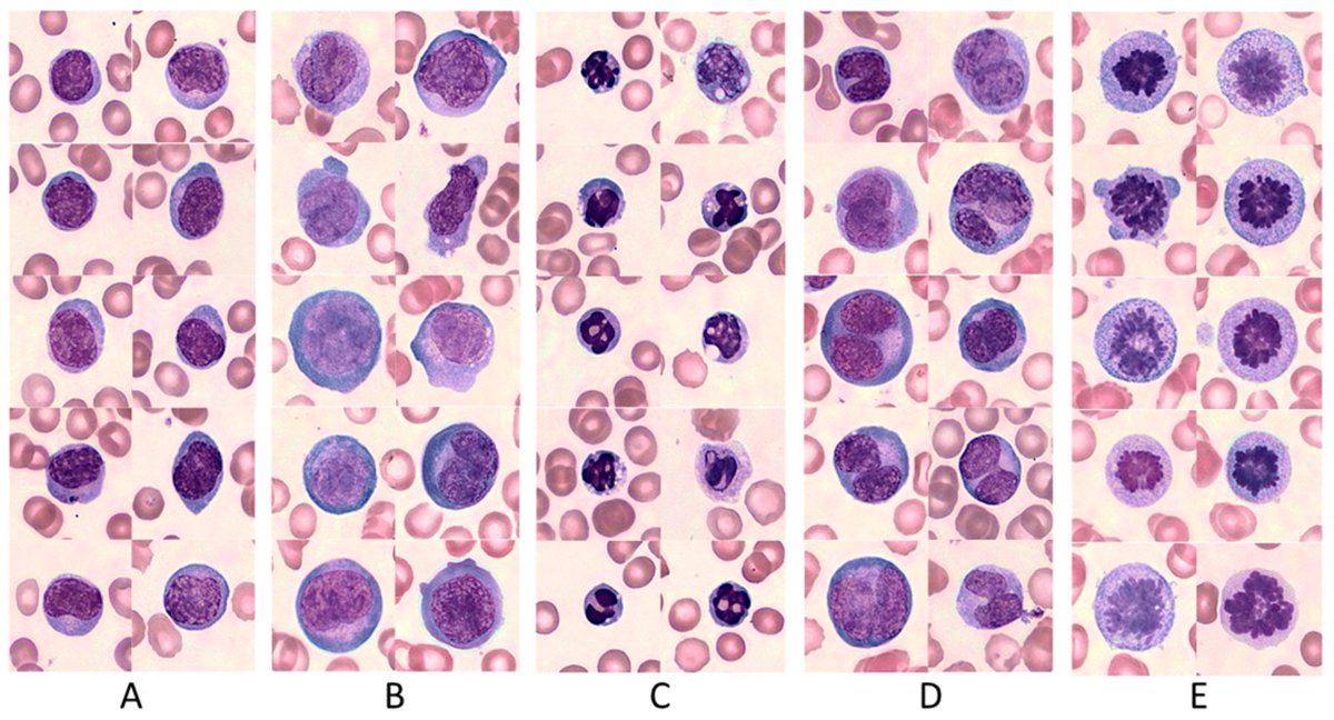 smbenlazar's tweet photo. The Clinical Significance of Circulating Lymphocytes Morphology in Diffuse Large B-Cell Lymphoma As Determined by a Novel, Highly Sensitive Microscopy https://t.co/NJL0E1JaIF #mdpicancers via @Cancers_MDPI #lymsm https://t.co/FfQAAo3GUy