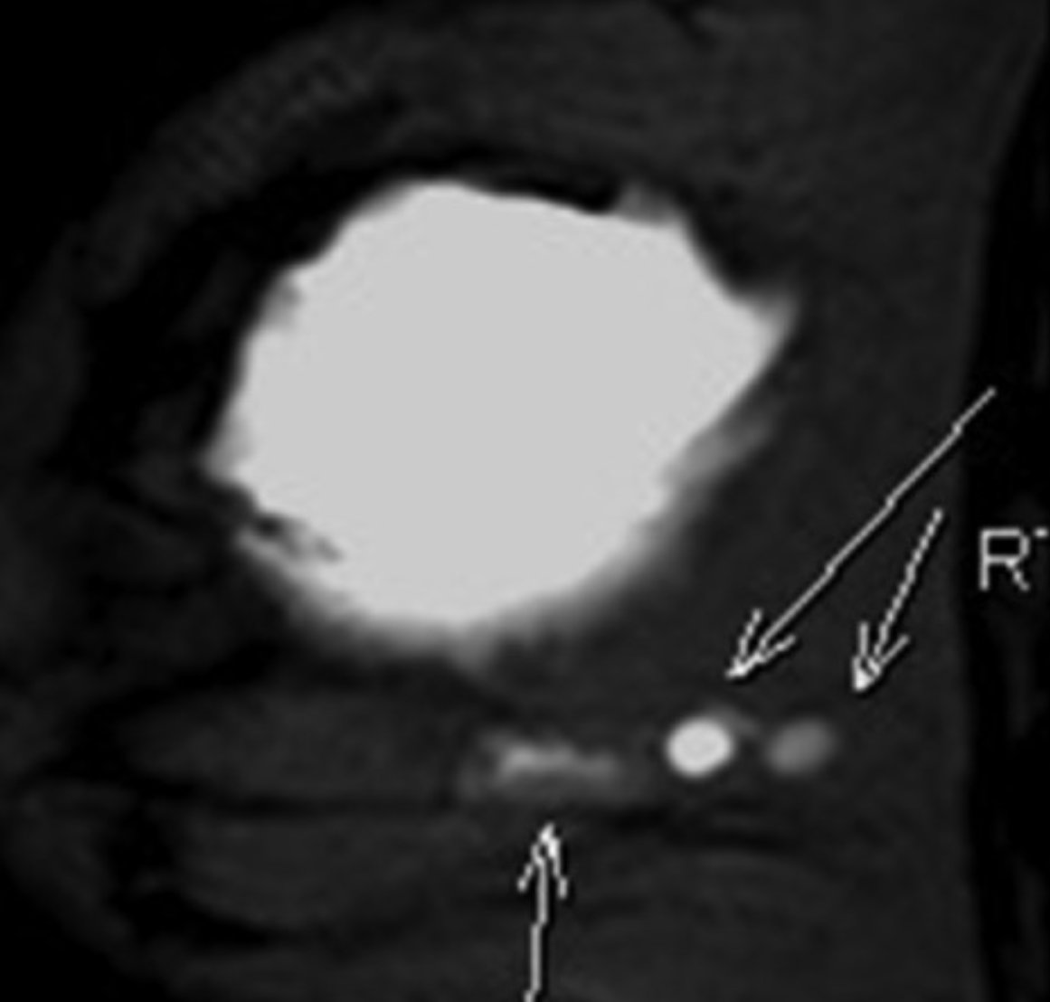 TheShorePath's tweet photo. Radiological-pathological correlation in breast in patient with history of silicone implants (MRI and H&amp;E) #pathology #pathX
@ElaineHuMD @Maicroanatomy @JuanPathMD @LordoftheSlides @GIJamesMD https://t.co/6Edu9Bdl0g