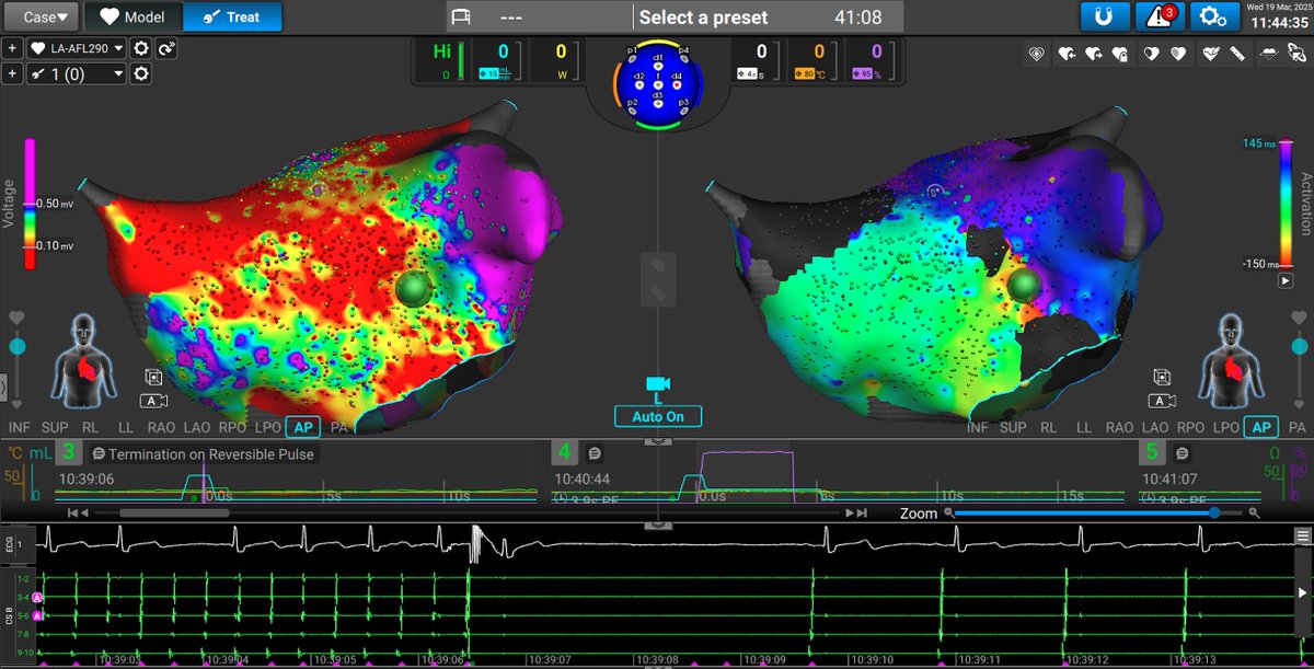 IDoundoulakis's tweet photo. Excited about our #sphere9 case with test pulse!
Join us at #EHRA2025 in Vienna (Live in the Box/Room 2/1st of April 08:30) where we’ll unveil exciting advancements in redo AF ablation beyond PVI. Don’t miss it!
Affera case with prof @AndreaSarkozy 
@LuigipannoneM @dogi84md https://t.co/nRfAdAkC7g