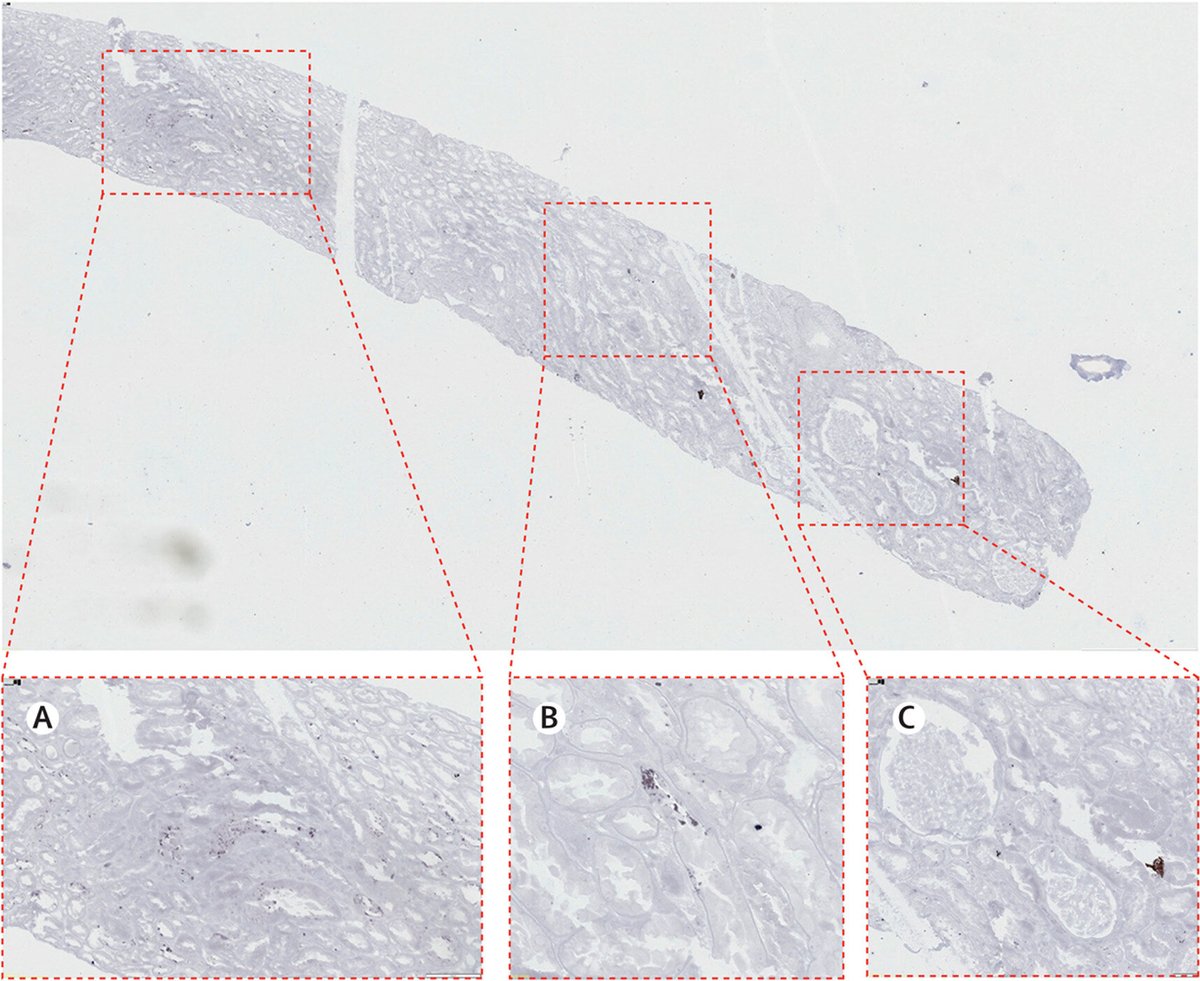 The Lancet (@thelancet) on Twitter photo 🆕 Case report in <a href="/TheLancetInfDis/">The Lancet Infectious Diseases</a>: Exploring parvovirus B19 pathogenesis and therapy among kidney transplant recipients.
A 34-year-old male recipient of an ABO-incompatible living donor kidney transplant who was repeatedly hospitalised for anaemia: hubs.li/Q03cvfHZ0 🆕 Case report in <a href="/TheLancetInfDis/">The Lancet Infectious Diseases</a>: Exploring parvovirus B19 pathogenesis and therapy among kidney transplant recipients.
A 34-year-old male recipient of an ABO-incompatible living donor kidney transplant who was repeatedly hospitalised for anaemia: hubs.li/Q03cvfHZ0