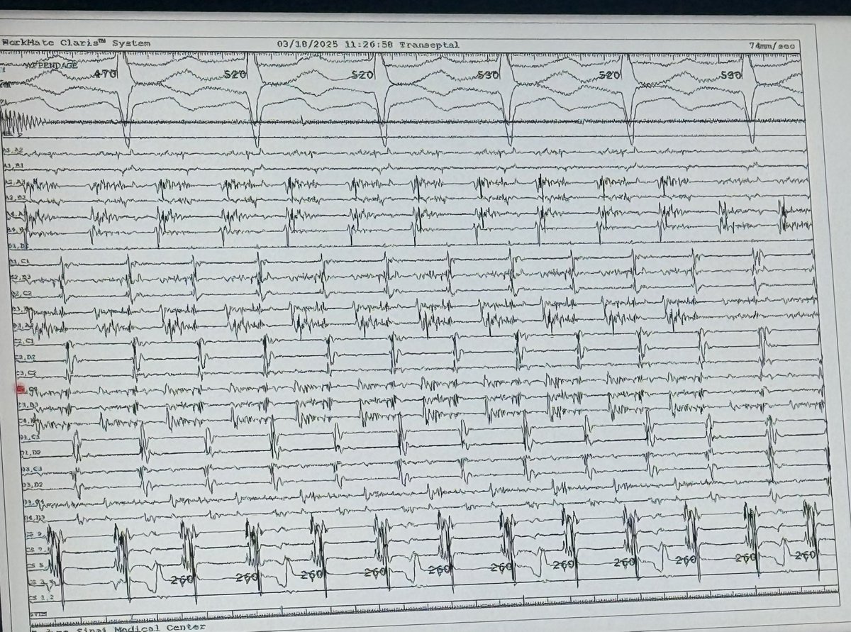 EugenioCingolan's tweet photo. #Morning #EPFellows @SmidtHeart @CMECedarsSinai @CedarsSinaiMed #Conference presented by senior #EPFellow Dr. John Cochran ➡️ #ReDo #Recurrent #AFL #EGMs #TimingWindow ➡️ #PFA vs. #RFA ⚡️⚡️ https://t.co/DLhybuuB08