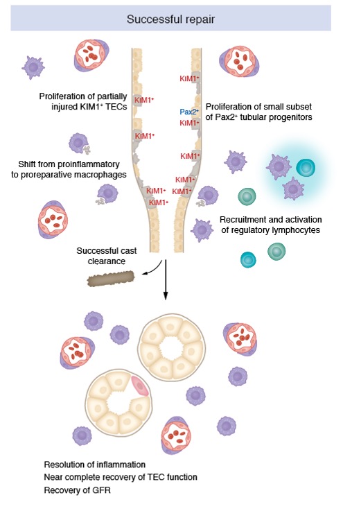 Journal of Clinical Investigation (@jclinicalinvest) on Twitter photo Acute kidney injury is frequently triggered by damage to tubular epithelial cells (TECs).
<a href="/meganlebaker/">Megan Baker</a> & <a href="/lloydcantley1/">Lloyd Cantley</a> <a href="/YaleMed/">Yale School of Medicine</a> review factors that contribute to functional recovery vs. failed repair in TECs and their translational implications. jci.org/articles/view/… Acute kidney injury is frequently triggered by damage to tubular epithelial cells (TECs).
<a href="/meganlebaker/">Megan Baker</a> & <a href="/lloydcantley1/">Lloyd Cantley</a> <a href="/YaleMed/">Yale School of Medicine</a> review factors that contribute to functional recovery vs. failed repair in TECs and their translational implications. jci.org/articles/view/…