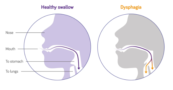 TherapyRJ's tweet photo. Attending Scotland Dysphagia CEN talk on aspiration pneumonia given by Dr John Ashford, who says:
"Muscle weakness is the number 1 underlying cause of oropharyngeal dysphagia"
🤕🏥🥤
#swallowaware2025 #dysphagia #aspiration https://t.co/9fH7qbe1RC