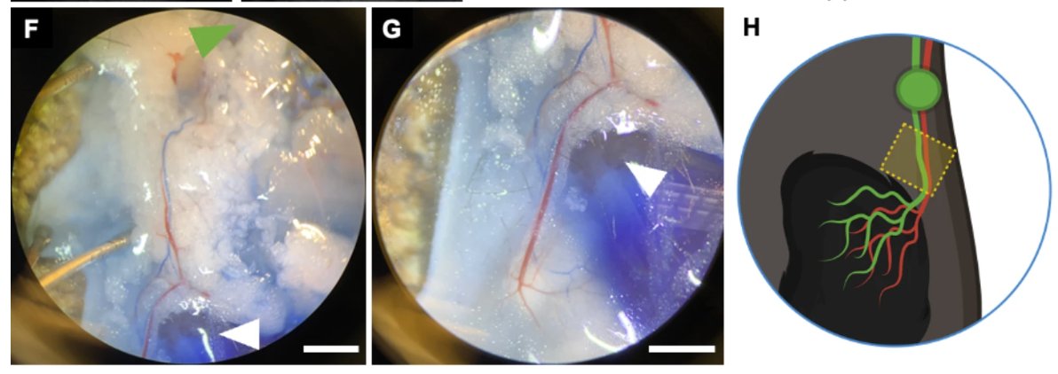 Center for Immunoengineering at Georgia Tech (@gatech_immuno) on Twitter photo Exciting new findings <a href="/SciReports/">Scientific Reports</a> from Center member <a href="/lymphengineer/">Brandon Dixon</a> Brandon Dixon, <a href="/GarciaLabGT/">GarciaLabGT</a>, & team suggest that preservation of functional tumor-draining lymphatic network may be essential towards a robust antitumor immune response. <a href="/MEGeorgiaTech/">Georgia Tech ME</a> nature.com/articles/s4159… Exciting new findings <a href="/SciReports/">Scientific Reports</a> from Center member <a href="/lymphengineer/">Brandon Dixon</a> Brandon Dixon, <a href="/GarciaLabGT/">GarciaLabGT</a>, & team suggest that preservation of functional tumor-draining lymphatic network may be essential towards a robust antitumor immune response. <a href="/MEGeorgiaTech/">Georgia Tech ME</a> nature.com/articles/s4159…