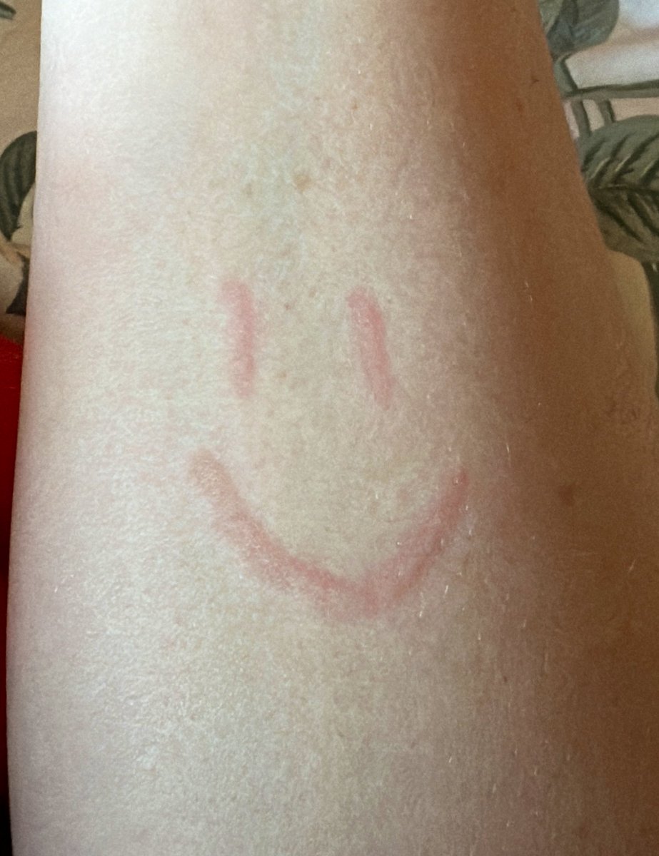 So it’s dermatographism, which I know is common but OOF knowing I’ll have to deal with it for years and it’s already impacted my day to day life these past 5 weeks is 0/10

Anyone have remedies or things they’ve found to help?

The skin writing is kinda fun aside from the burning