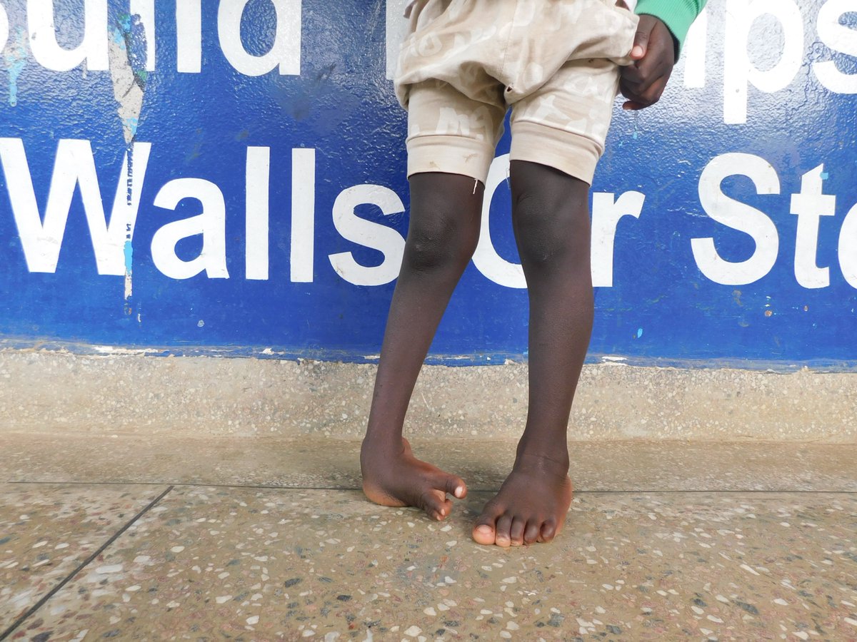 Ruharo Mission Hospital (@ruharohospital) on Twitter photo Clubfoot is a treatable condition if interventions are initiated early. Without treatment, it leads to severe complications and limitations in functioning.
#Earlyinterventions #Clubfoot
<a href="/cbmIHI/">CBM Inclusive Health Initiative</a> <a href="/cbmDeutschland/">CBM Christoffel-Blindenmission in Deutschland</a> <a href="/cbmWorldwide/">CBM Christian Blind Mission</a> <a href="/TBekson/">Dr Bekson Tayebwa ๐</a> <a href="/NDYOWAAWE/">NDYOWAAWE</a> <a href="/MosesOkipi/">Moses Onyait Okipi</a> <a href="/themwanjap/">themwanjap</a> Clubfoot is a treatable condition if interventions are initiated early. Without treatment, it leads to severe complications and limitations in functioning.
#Earlyinterventions #Clubfoot
<a href="/cbmIHI/">CBM Inclusive Health Initiative</a> <a href="/cbmDeutschland/">CBM Christoffel-Blindenmission in Deutschland</a> <a href="/cbmWorldwide/">CBM Christian Blind Mission</a> <a href="/TBekson/">Dr Bekson Tayebwa ๐</a> <a href="/NDYOWAAWE/">NDYOWAAWE</a> <a href="/MosesOkipi/">Moses Onyait Okipi</a> <a href="/themwanjap/">themwanjap</a>