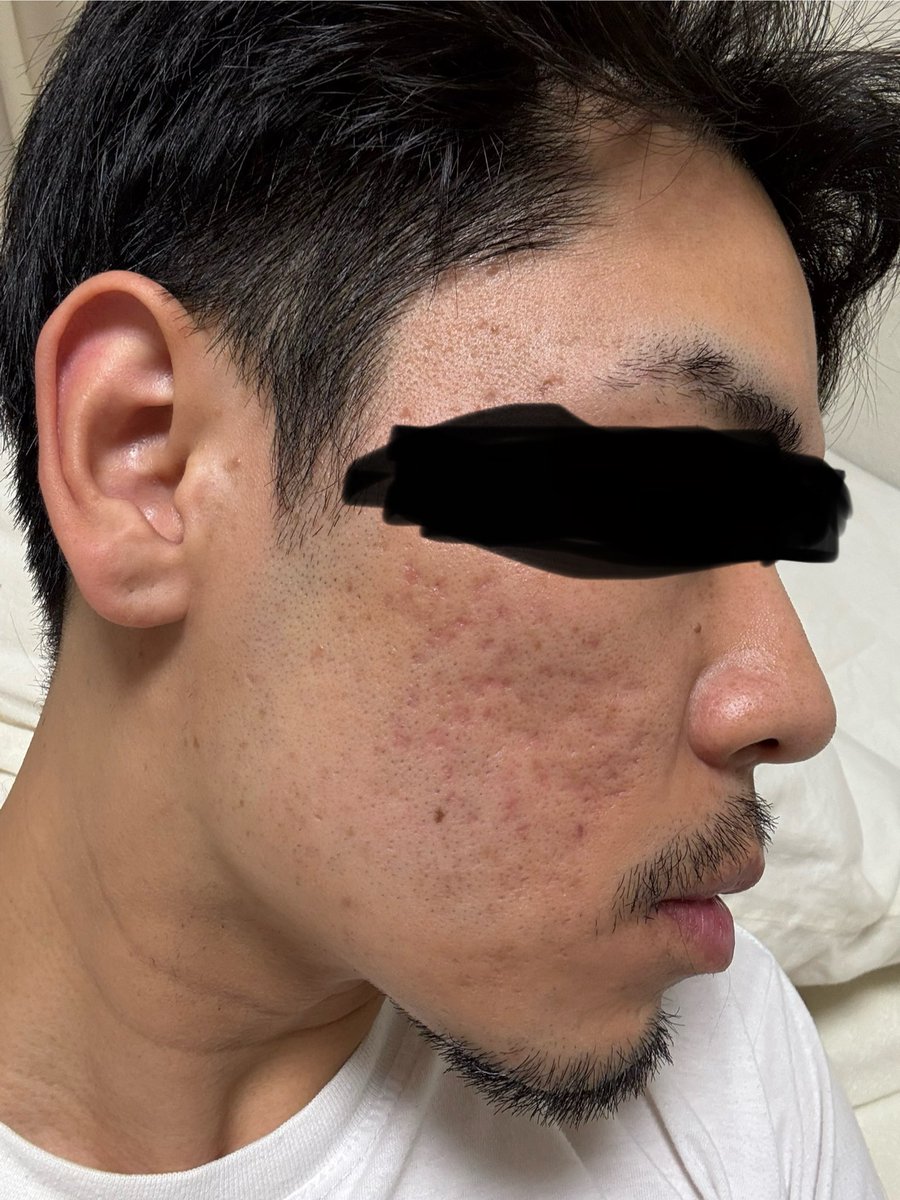 nikibman's tweet photo. グランメド炭酸ガスレーザーのみDT約3ヶ月です！以前より赤みはマシ？になった気がします。

まだまだ時間がかかりそう...🫠

赤みが早く引く施術何かないかな〜
赤みがちゃんと引いてからじゃないとクレーターがマシになったかの判断も出来ないしな〜 https://t.co/5XaNLu6pwN
