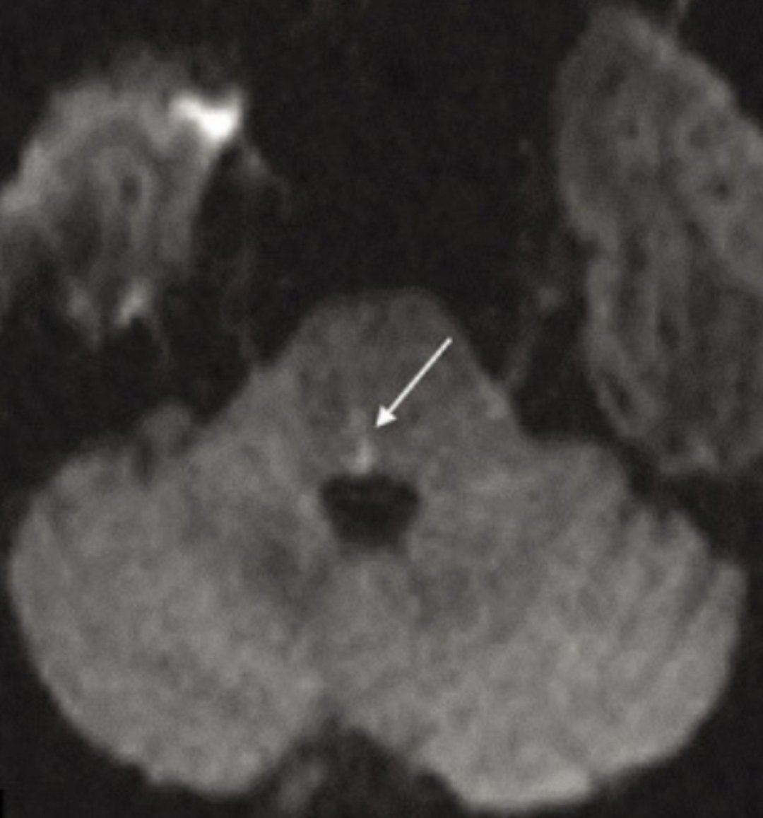 PeteFiesterMD's tweet photo. Actual Hx:  "Internuclear Opthalmoplegia (INO)" 😯

🧠 MRI = small right MLF stroke.  

(Disrupts CN VI nuclei via PPRF ➡️ weakens ipsilateral eye adduction, but preserves contralateral eye abduction.)

Shout out to this awesome neurology resident for making my job easy! 😎 https://t.co/G1Pm6crVWQ