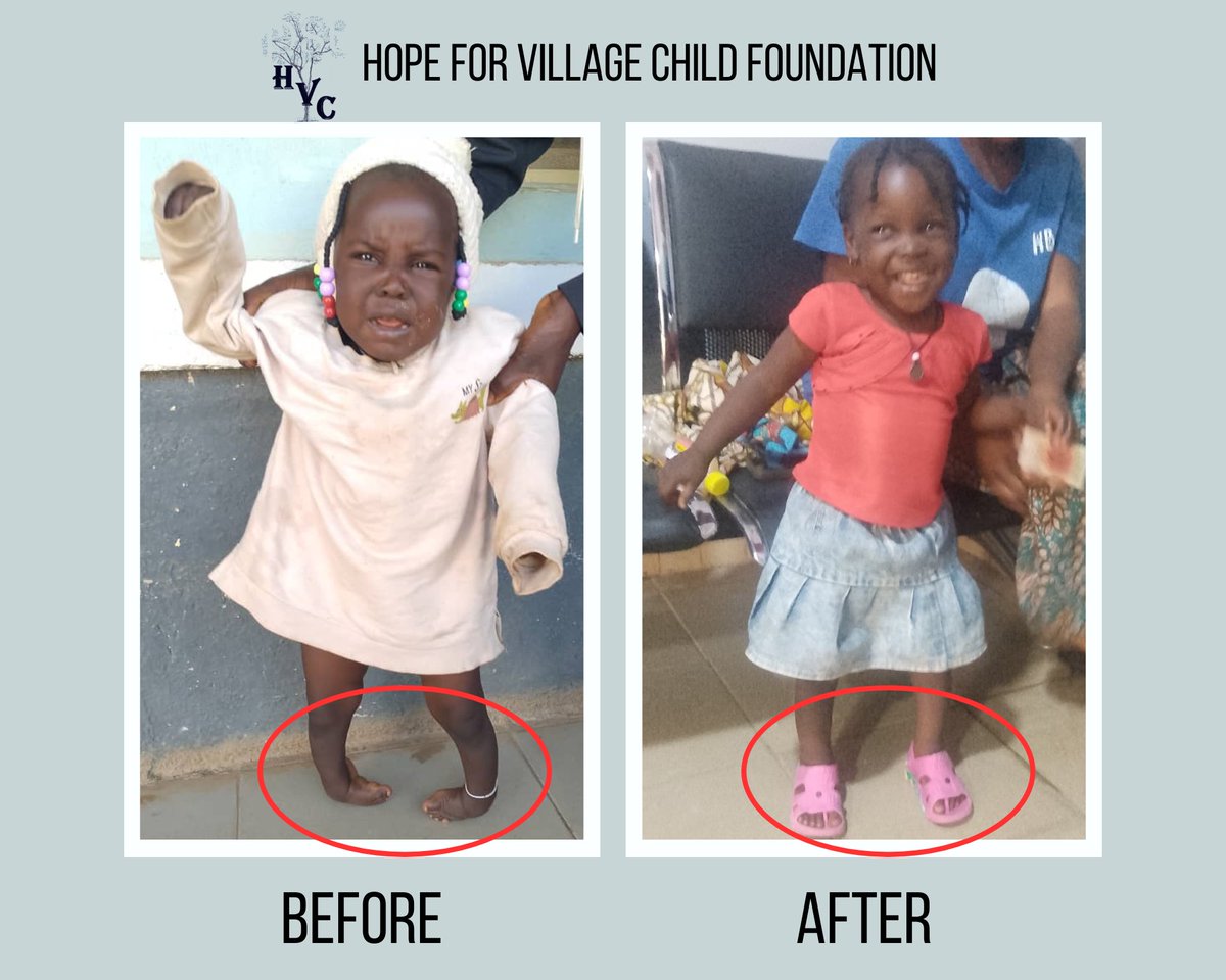 From tears to triumph! 

This little warrior once faced the challenges of clubbed feet, but today, she stands with joy and laughter after a successful correction by Hope for Village Child Foundation. Every child deserves the chance to walk, run, and play without limits.✨💙