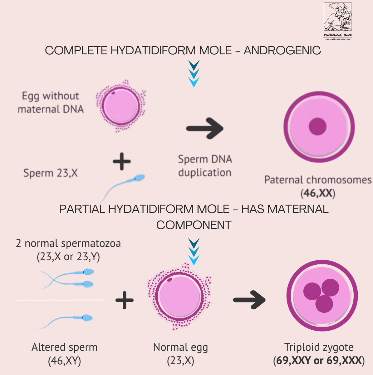 Pathology_mcqs's tweet photo. 🔬 p57 Interpretation in Molar Pregnancy 🧬

A helpful adjunct in difficult cases. https://t.co/ElsY0rgF5j