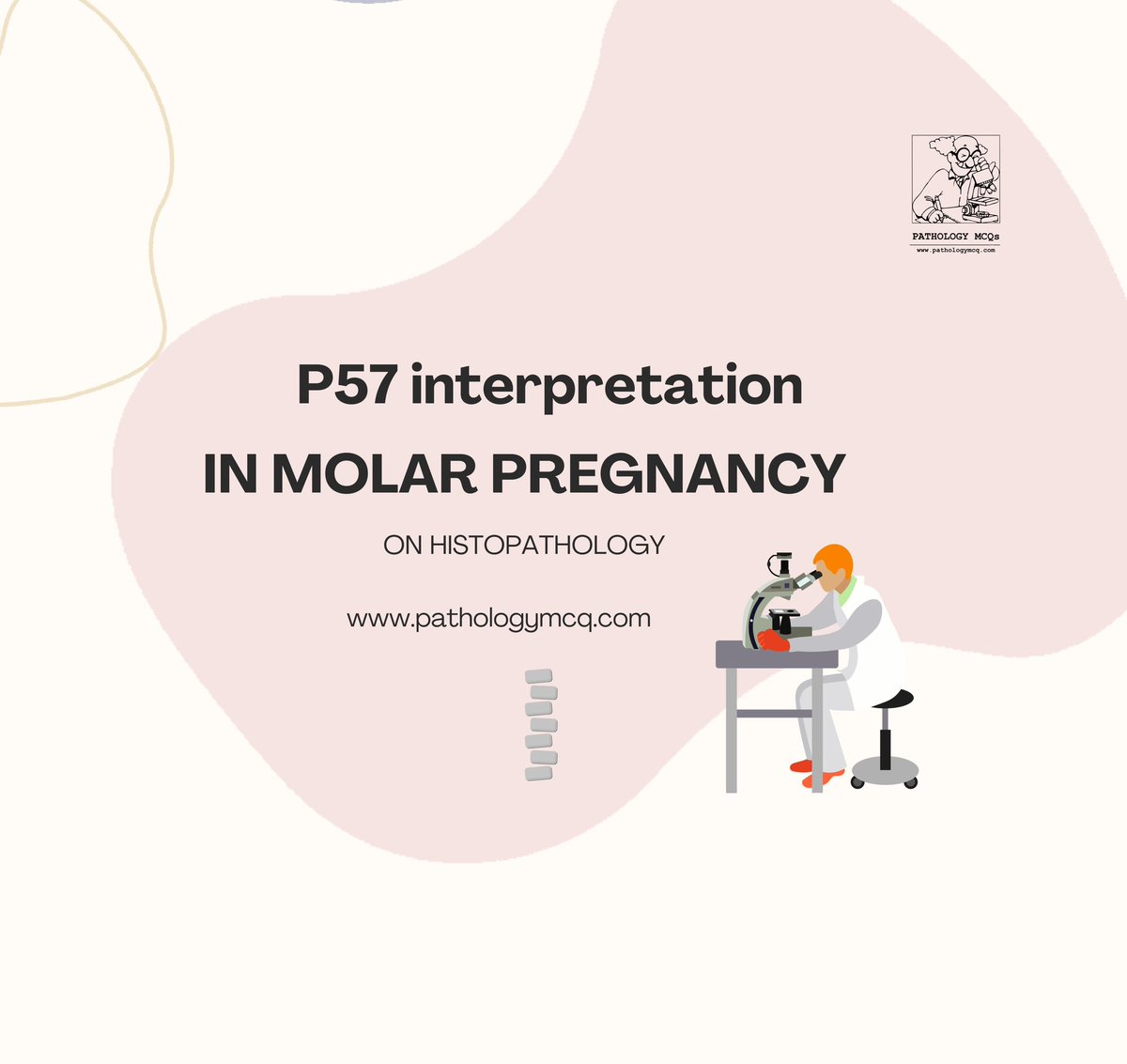 Pathology_mcqs's tweet photo. 🔬 p57 Interpretation in Molar Pregnancy 🧬

A helpful adjunct in difficult cases. https://t.co/ElsY0rgF5j