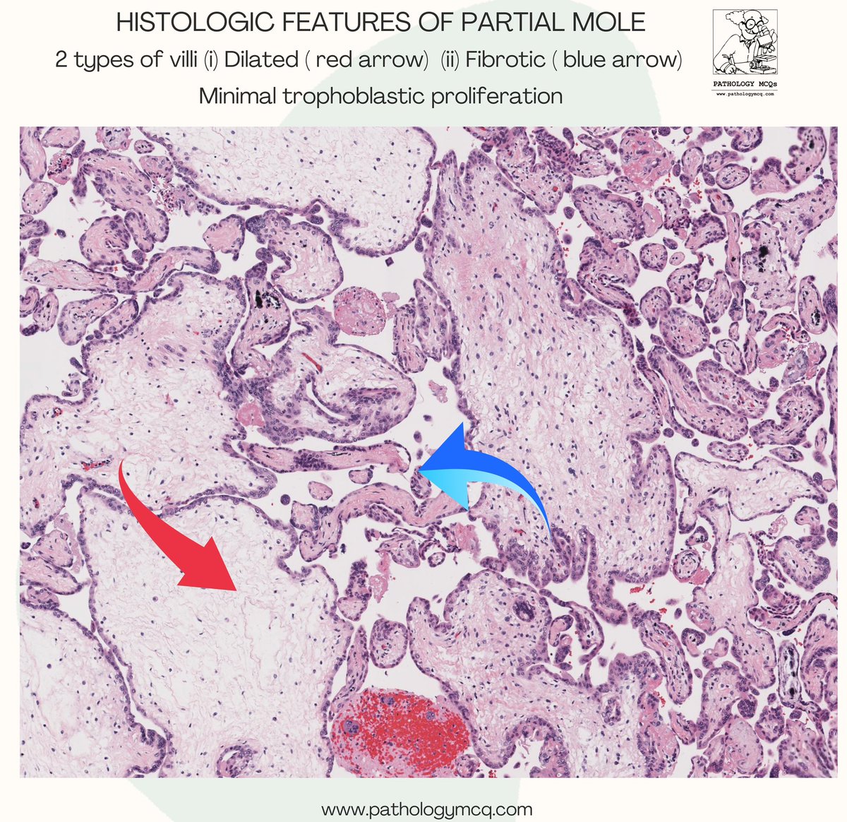 🔬 p57 Interpretation in Molar Pregnancy 🧬

A helpful adjunct in difficult cases.