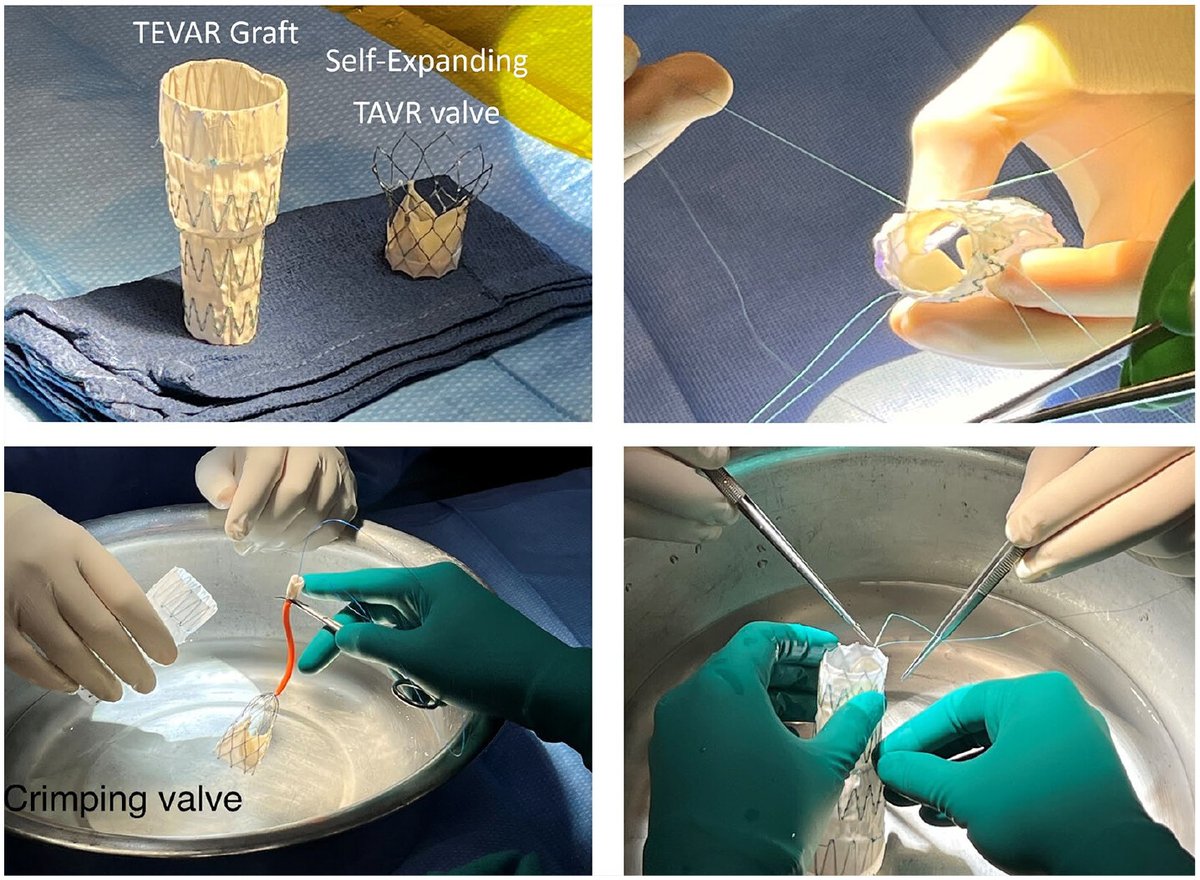 Innovations Journal (@innovationsjour) on Twitter photo Last article in our Vol 19, Issue 5 Focused Topic Series is from Drs <a href="/dr_ghoreishi/">Mehrdad Ghoreishi</a> and <a href="/Toursavadkohi/">Shahab</a> on the 10 Commandments of Endo-Bentall repair
Read free: doi.org/10.1177/155698…
#Endovascular #AorticRoot #TEVAR @ouzounianmd <a href="/DrWheatley/">Grayson Wheatley</a> <a href="/AortaSurg/">Kim de la Cruz, MD FACS FACC FCCP</a> Last article in our Vol 19, Issue 5 Focused Topic Series is from Drs <a href="/dr_ghoreishi/">Mehrdad Ghoreishi</a> and <a href="/Toursavadkohi/">Shahab</a> on the 10 Commandments of Endo-Bentall repair
Read free: doi.org/10.1177/155698…
#Endovascular #AorticRoot #TEVAR @ouzounianmd <a href="/DrWheatley/">Grayson Wheatley</a> <a href="/AortaSurg/">Kim de la Cruz, MD FACS FACC FCCP</a>