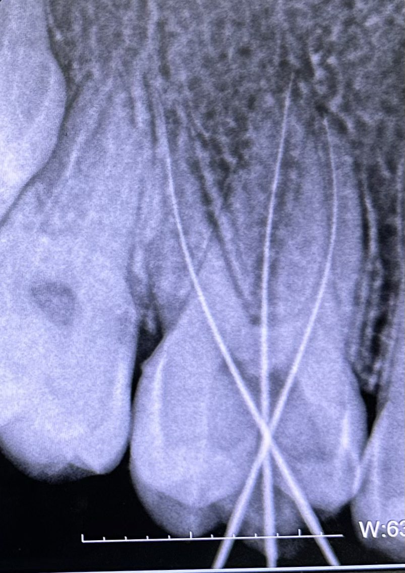 trigeminal_V's tweet image. Last endo ever 💀