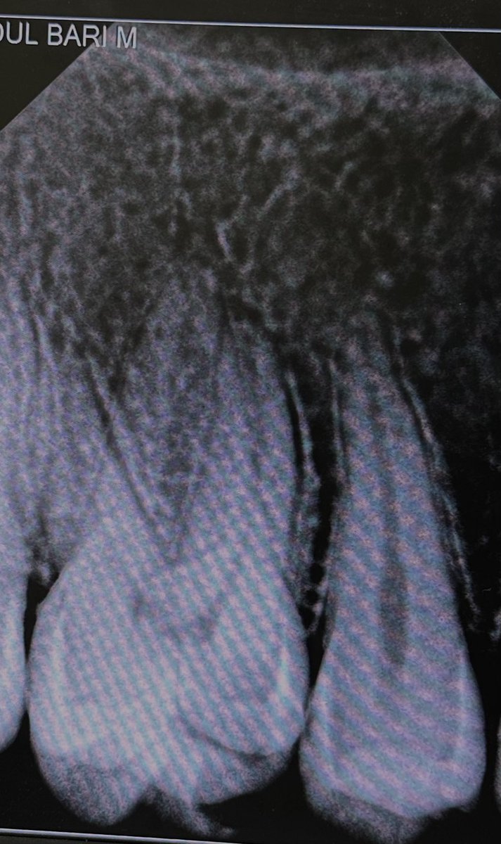 trigeminal_V's tweet image. Last endo ever 💀