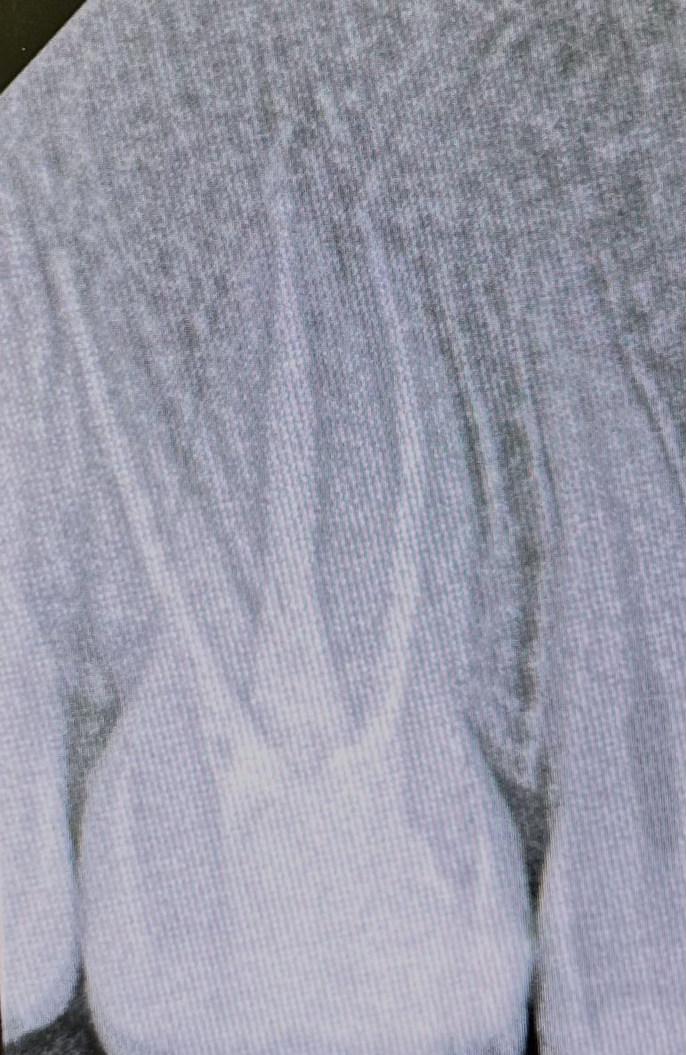 trigeminal_V's tweet image. Last endo ever 💀