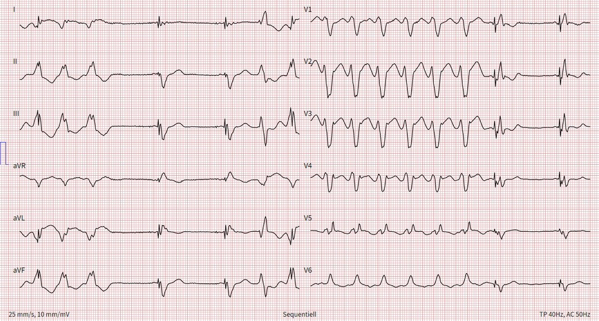 Lorin Braschler, MD (@cardiodevotee) on Twitter photo 68yo male
Palpitations
Known ICM HFrEF (LVEF 36%) with CRT-D
Dx? Rhythm?
<a href="/ecgandrhythmRoe/">Dr. Andreas Roeschl</a>
<a href="/EcgOxford/">đ«EcgOxford</a>
<a href="/DrRazi4/">Dr Razi</a>
<a href="/PendellM/">Pendell Meyers</a>
<a href="/RobertHermanMD/">Robert Herman, MD, PhD</a>
<a href="/Arron_Pearce_/">Arron Pearce</a>
<a href="/ECGwithReid/">ECG Reid</a>
<a href="/EM_Resus/">Sam Ghali, M.D.</a>
@PMcardioBot
#ECG #CardioTwitter #MedTwitter #MedX 68yo male
Palpitations
Known ICM HFrEF (LVEF 36%) with CRT-D
Dx? Rhythm?
<a href="/ecgandrhythmRoe/">Dr. Andreas Roeschl</a>
<a href="/EcgOxford/">đ«EcgOxford</a>
<a href="/DrRazi4/">Dr Razi</a>
<a href="/PendellM/">Pendell Meyers</a>
<a href="/RobertHermanMD/">Robert Herman, MD, PhD</a>
<a href="/Arron_Pearce_/">Arron Pearce</a>
<a href="/ECGwithReid/">ECG Reid</a>
<a href="/EM_Resus/">Sam Ghali, M.D.</a>
@PMcardioBot
#ECG #CardioTwitter #MedTwitter #MedX