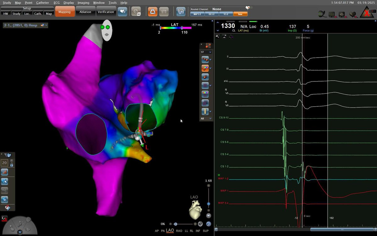 Laila_G's tweet photo. 21 y/o patient with 210 bpm SVT left PL concealed AP. Transeptal approach with Open window mapping Octaray and CARTO 3 system. #ePeeps #Cardiology @CardiologiaHULA @Ana_delaPuente https://t.co/SIiwzP1OfQ