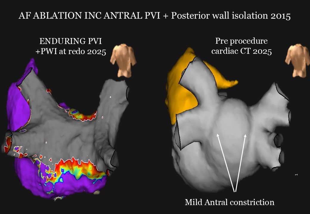 Redo procedure for very late AF recurrence post PVI+PWI 2015. Cardiac CT pre shows mild antral “stenosis” &amp; correlated with enduring PVI&amp; PWI