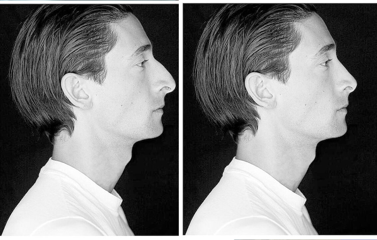 tremenduca's tweet image. Dios bendiga las narices grandes que hacen que los rostros pasen de anodinos a con personalidad. Todos ellos con una rinoplastia serían más normativos y atractivos y más irrelevantes y olvidables.