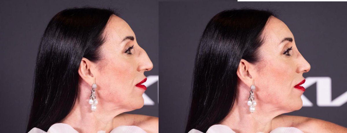 tremenduca's tweet image. Dios bendiga las narices grandes que hacen que los rostros pasen de anodinos a con personalidad. Todos ellos con una rinoplastia serían más normativos y atractivos y más irrelevantes y olvidables.