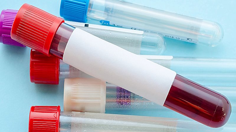 La detección de niveles circulantes de adipoquinas y de gamma-glutamil transferasa (GGT) permitió identificar de manera temprana la presencia de síndrome metabólico.
ms.spr.ly/6016qneKI