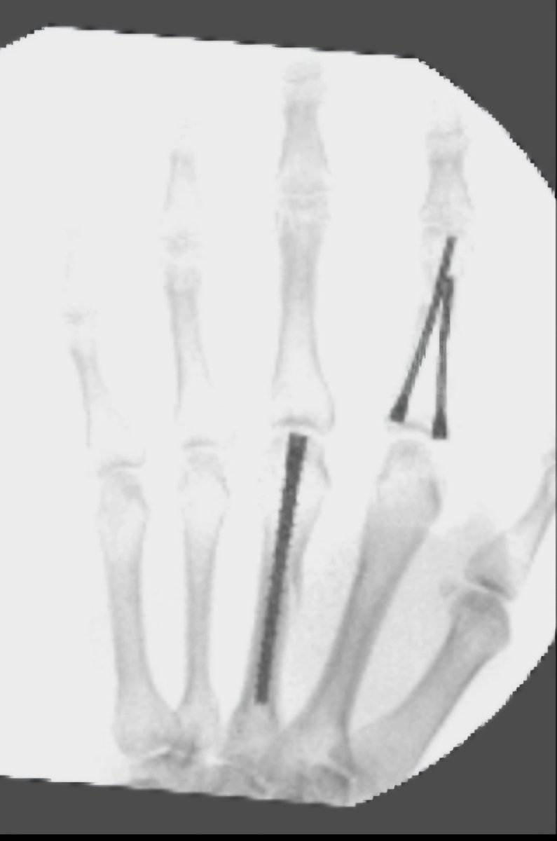 LLovegoodt's tweet photo. Welp, that's the reconstructive attempt on my hand. Finally feeling better. Had to definitely figure out how to work around this 😅
#WhatThatMouthDo 🫠 https://t.co/BQushJXcNg
