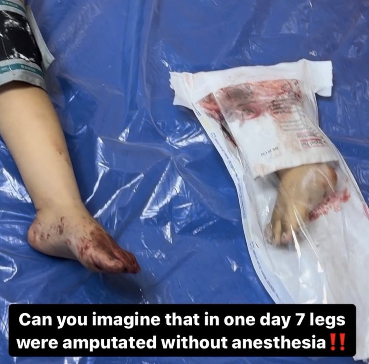 swilkinsonbc's tweet photo. Gaza hospitals are catastrophic: amputations performed on children without anesthesia; screams of unimaginable pain | @dn_osama_rabee https://t.co/fLMic2ccvP