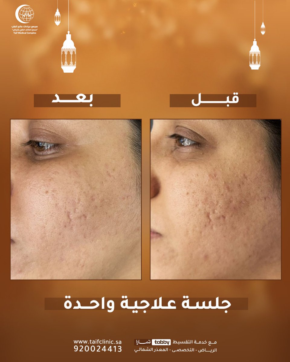 taifmcmc's tweet photo. علاج جميع مشاكل البشرة في جلسة واحدة🤩

احـجـز موعدك الأن 920024413 ☎

واتـسـاب

📱0534731212
📱0554220773
📱0554113315

📍 موقعنا:
الرياض - المعذر الشمالي - شارع التخصصي https://t.co/6xtn5EJfxW