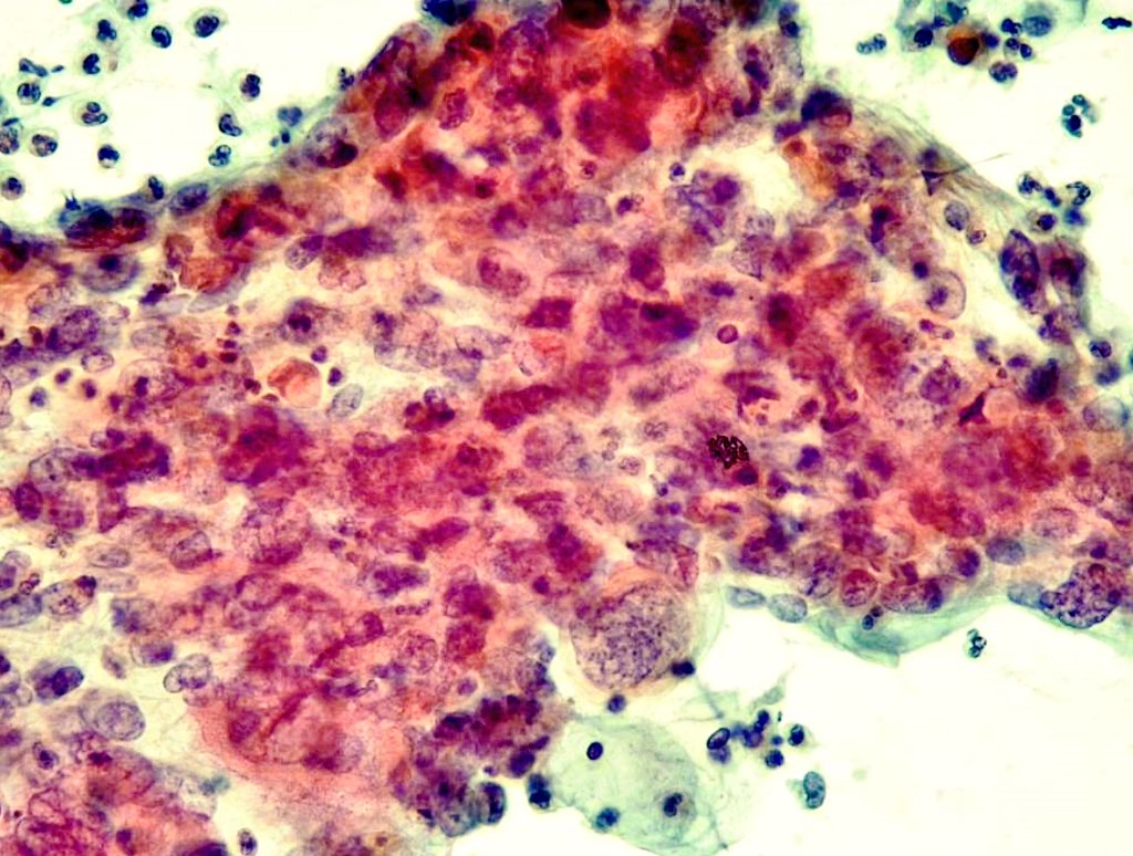 Citopatoroxx's tweet image. Very bizarre cells and necrotic background in this squamous cell carcinoma. 

Carcinoma epidermoide con un fondo muy necrótico y células pleomórficas, anormales y ahusadas. 

#cytopath #paptest #cervicalcytology