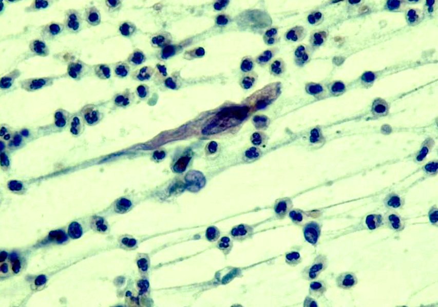 Citopatoroxx's tweet image. Very bizarre cells and necrotic background in this squamous cell carcinoma. 

Carcinoma epidermoide con un fondo muy necrótico y células pleomórficas, anormales y ahusadas. 

#cytopath #paptest #cervicalcytology