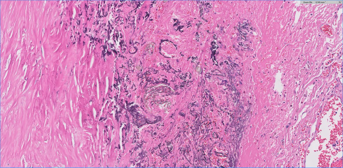 #GUpath🧩time!

adult human with renal mass, no prior malignancies, undergoes radical nephrectomy showing a chromophobe RCC

👀🔬anything?🤨