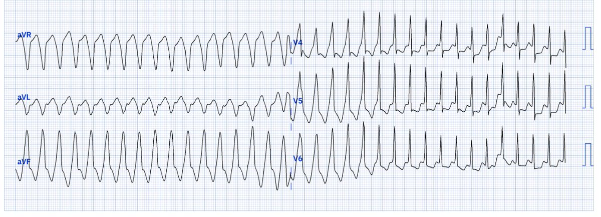 ECG.Hacks (@ekghacks) on Twitter photo Wednesday... the belly button of the week, let's make it interesting with a cool trace: 57 yo female, no history of disease, brought to the ER for palpitations... What is your iDx?
Would be honored to have expert opinion on this one! <a href="/adribaran/">Adrian Baranchuk MD FACC FRCPC FCCS FSIAC</a> <a href="/SergioPinski/">Sergio Pinski</a> <a href="/ecgandrhythmRoe/">Andreas Roeschl, MD</a> Wednesday... the belly button of the week, let's make it interesting with a cool trace: 57 yo female, no history of disease, brought to the ER for palpitations... What is your iDx?
Would be honored to have expert opinion on this one! <a href="/adribaran/">Adrian Baranchuk MD FACC FRCPC FCCS FSIAC</a> <a href="/SergioPinski/">Sergio Pinski</a> <a href="/ecgandrhythmRoe/">Andreas Roeschl, MD</a>