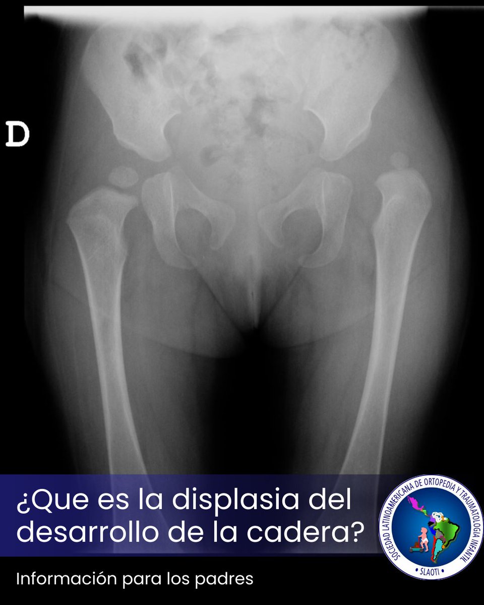 La DDC es una de las deformidades mas serias en la Ortopedia Infantil, ya que su diagnostico tardío resulta en complicaciones graves en el niño y el adulto

Mas info en: linktr.ee/slaoti

#displasiadecadera #luxaciondecadera #luxación #ortopediainfantil #pediatria #slaoti
