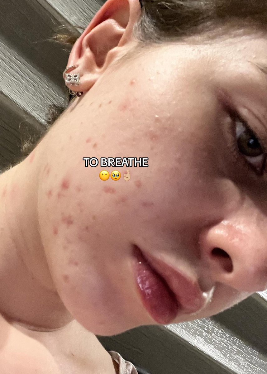 ethereallydaisy's tweet image. Terjumpa video a girl yang share journey acne dia. Amazed gilaaa tengok dia berjaya dapat flawless skin balik in 2 months je🥹🫶🏻