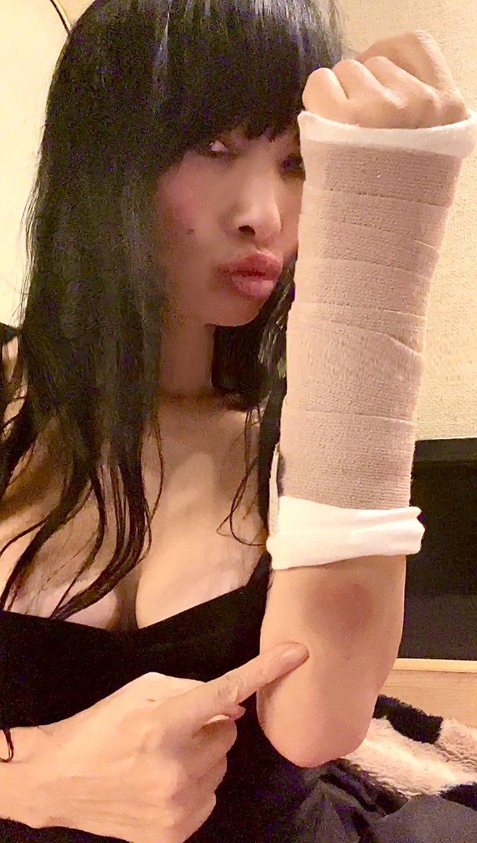 Will you help me? Wow can’t believe Huge #bruce still on my arm after many days.? playing #tennis fell hurt my #wrist wentto #urgentcare got #xray my #born is broken read instagram.com/p/DHaA0lPRCHb/… what should I doto heal? Anytips? #fashionshop bailinghollywoodshop.com #bailingmovie