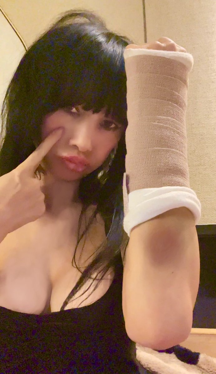 RealBaiLing's tweet photo. Will you help me? Wow can’t believe Huge #bruce still on my arm after many days.? playing #tennis fell hurt my #wrist wentto #urgentcare got #xray my #born is broken read https://t.co/Runt5gsWmd what should I doto heal? Anytips? #fashionshop https://t.co/cB6RRfo0Wu #bailingmovie https://t.co/Xi7xNKT2nr