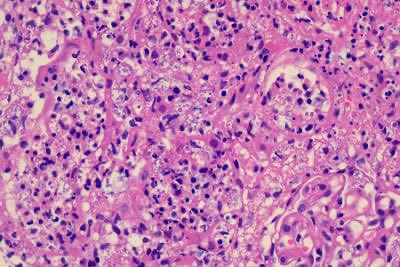 RenalPathLabs's tweet image. When the minute creatures colonise and destruct a young graft & are visible without culture plates-They need a Trump (tough) antibiotic administrator..Urine culture -Klebsiella+ (PAS+ organism) #RenalPath #PathTwitter #NephTwitter #AskRenal #RenalPathLabsGGN