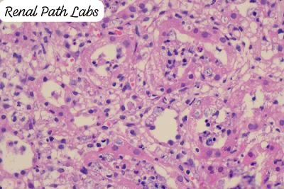 RenalPathLabs's tweet image. When the minute creatures colonise and destruct a young graft & are visible without culture plates-They need a Trump (tough) antibiotic administrator..Urine culture -Klebsiella+ (PAS+ organism) #RenalPath #PathTwitter #NephTwitter #AskRenal #RenalPathLabsGGN
