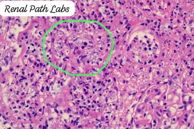 RenalPathLabs's tweet image. When the minute creatures colonise and destruct a young graft & are visible without culture plates-They need a Trump (tough) antibiotic administrator..Urine culture -Klebsiella+ (PAS+ organism) #RenalPath #PathTwitter #NephTwitter #AskRenal #RenalPathLabsGGN