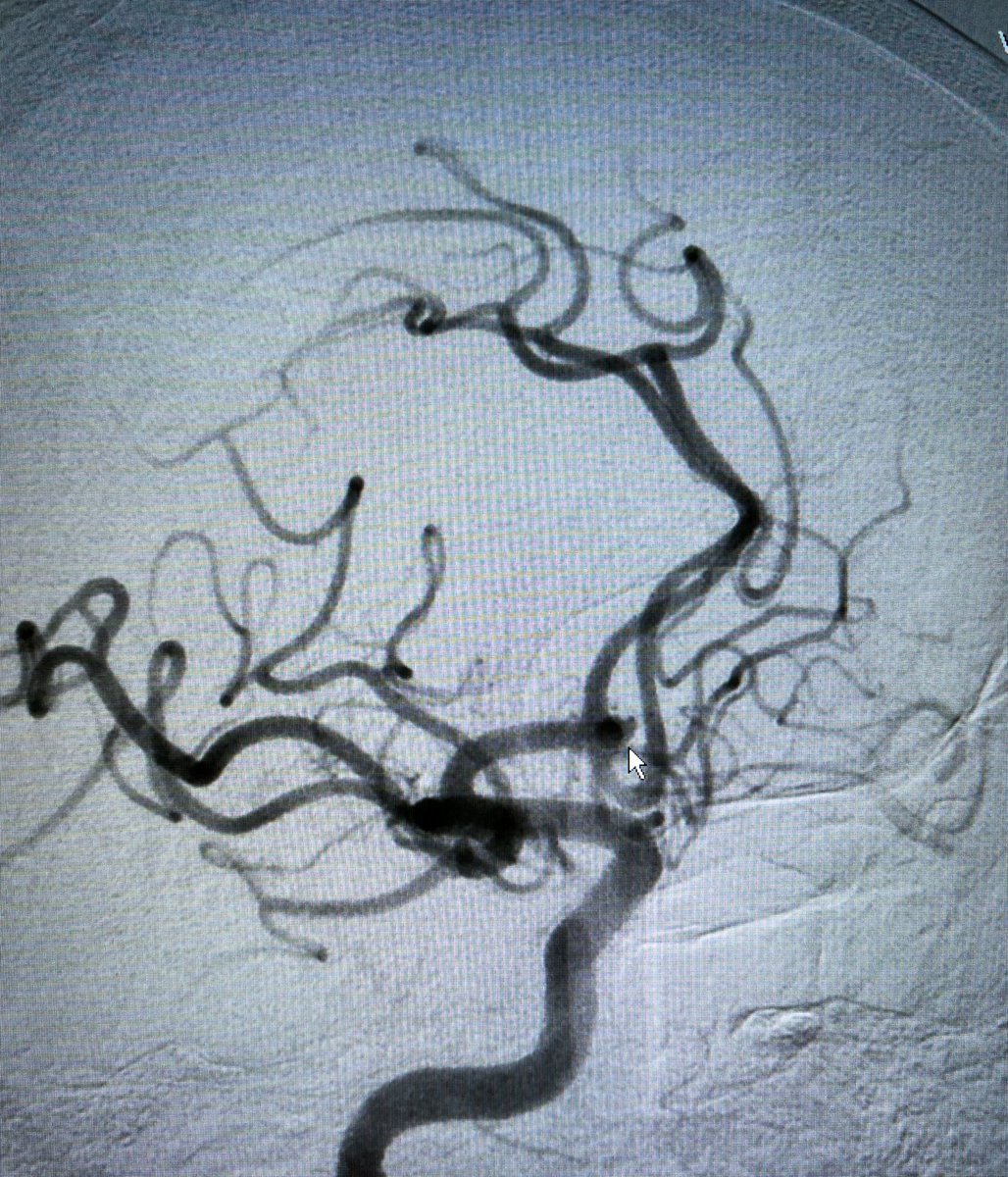 TENeurologica's tweet photo. #Aneurysm #Jailling #Stent #Coilling @INNNMVS #Mexico #Neuro #neuroscience #Neurology #neuron https://t.co/bTHcbKDk0J