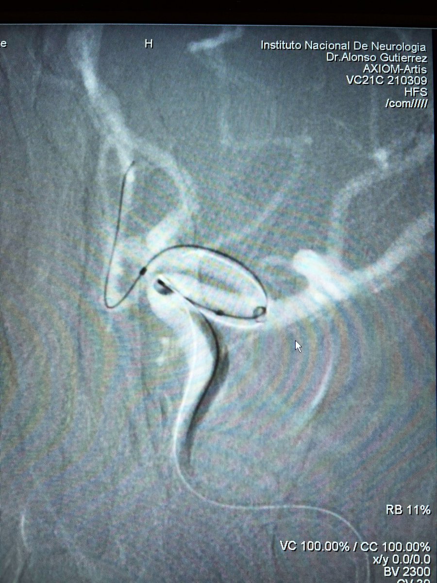 TENeurologica's tweet photo. #Aneurysm #Jailling #Stent #Coilling @INNNMVS #Mexico #Neuro #neuroscience #Neurology #neuron https://t.co/bTHcbKDk0J