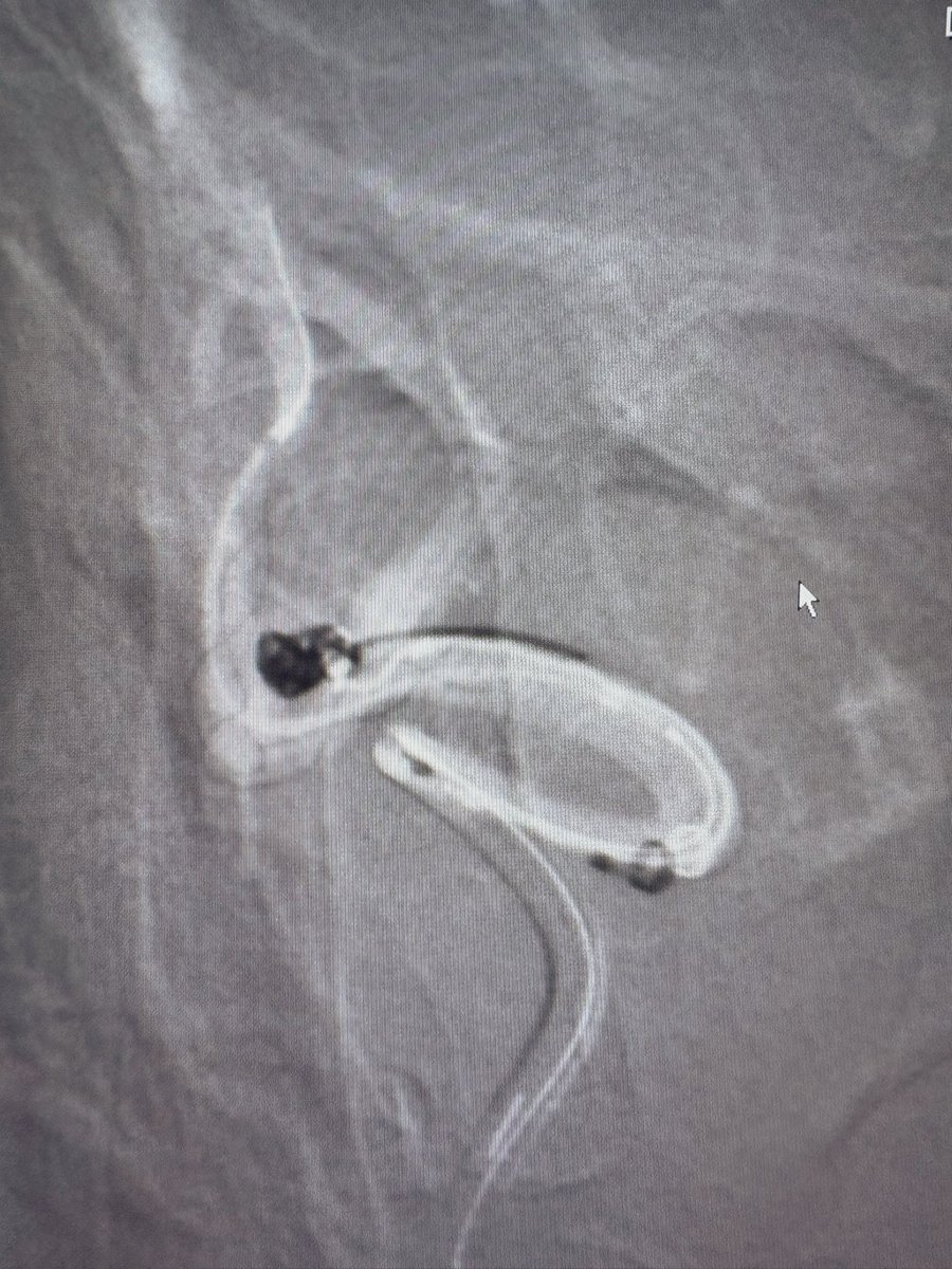 TENeurologica's tweet photo. #Aneurysm #Jailling #Stent #Coilling @INNNMVS #Mexico #Neuro #neuroscience #Neurology #neuron https://t.co/bTHcbKDk0J