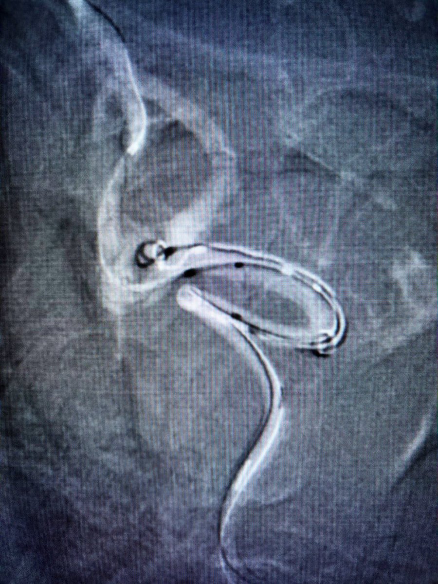 TENeurologica's tweet photo. #Aneurysm #Jailling #Stent #Coilling @INNNMVS #Mexico #Neuro #neuroscience #Neurology #neuron https://t.co/bTHcbKDk0J