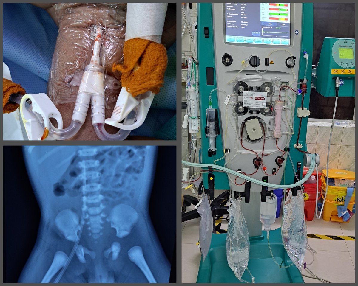arunkrishnan_b's tweet photo. 2 weeks old neonate , 2.5kg , urea cycle disorder, CRRT done to tide over the hyper ammonia crisis after Peritoneal dialysis failed to give desired effect , discharged home with special formula and breast feeds top up after a week https://t.co/6n9LGN534J