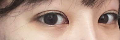 UANDDN's tweet image. #手術日記 #ユニーク整形外科

二重再手術してからもう2週間経ったけど、すごい…
最初の手術よりも腫れが引くのが早い気がする！
え、もしかして腕がいいと腫れも早く引くの…？
ラインもめっちゃ綺麗で大満足！