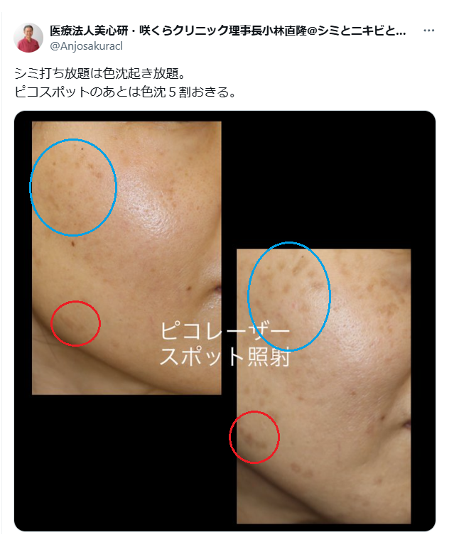 qu1ckm0t1on's tweet photo. そもそも咲くらクリニック小林直隆氏が間違っているのです。

実際のシミ治療においては

①通常、シミは多数あり、濃いシミもあれば薄いシミもある。
②ある程度濃いシミに関してはスポット照射が有効な場合があり、スポット照射を行う。
③スポット照射以外のシミに関してはレーザートーニング、フォト（ステラM22、ルメッカなど）、ピココンビなどを行ってシミを薄くする。
④全体的に言えることだが、トラネキサム酸・ビタミンC（シナール）・ビタミンE（ユベラ）を内服する。

という治療方針です。

基本的に②の場合、
「スポット照射はシミを根治させる」
に近い働きがあります（それでもたまに再発することがあります）。
しかし、薄いシミにスポット照射を行うと色素沈着を起こす可能性が高くなるため、③④で抑えるしか出来ないのです。
③に関しては、深さや濃さによって効きやすい機械が違ってきますので、様々の器械を試してみるというのも一つの方法です。
しかし、これに対して
美容クリニックの作戦A＝カスタマイズ治療と称して「薄いシミでもこれで有効ですよ」と言う。
美容クリニックの作戦B＝「ルビーフラクショナル一択です」などと誘導される
などをされたりするわけですが、患者さんの無知に付け込んでいる場合が多いので注意が必要です。
そんなに簡単な事ではないのです。試してみて初めて分かるというケースが非常に多いです。
また、抑えることはある程度可能でも、根治出来る場合が少ないので、「また出てくる」ということになります。
クリニックの作戦Aや作戦Bで一杯お金を使ってもまた一杯お金を使うことになります。
もっと、建設的に考えるべきではないかと思います。

この方のケースですが、小林氏は全てのシミに対してスポット照射を行っています。
実際に診てみないと分からない面はありますが、この方の場合でも、スポット照射できるシミはあったかもしれません。
しかし、それは、全体の一部であってほとんどのシミは③④の治療になるでしょう。
それに対してスポット照射を行えばリスクがものすごく上がるのです。

仰るように皆さんが悩んでいらっしゃるシミのほとんどが
「スポット照射が出来ないシミ」
ということになります。
すると、長い付き合いになってしまうわけですから、「自分に合った治療を探す」
ということも必要になってきます。
弊社ではある程度、良い治療をご提案できると思いますが、弊社の先生、ナース、スタッフのほぼ全員がそこまで自信がありません。
結構、頑張ってるんですが。
「やってみないと分からない」という面があるからです。これはいくら頑張っても変わらないでしょう。

ところが、それを分かった風に各連中が腐るほどいます。
儲かって羨ましいです。

追伸：
この方は、どういう設定だったのかは分かりませんが、それにしても、炎症後色素沈着が激し過ぎます。
一番初めに
「一体、どんな施術をやったんだろう？」
と感じました。
弊社のある院長先生は
「それにしても下手。〇〇クリニックレベルに下手」
と仰っていました。