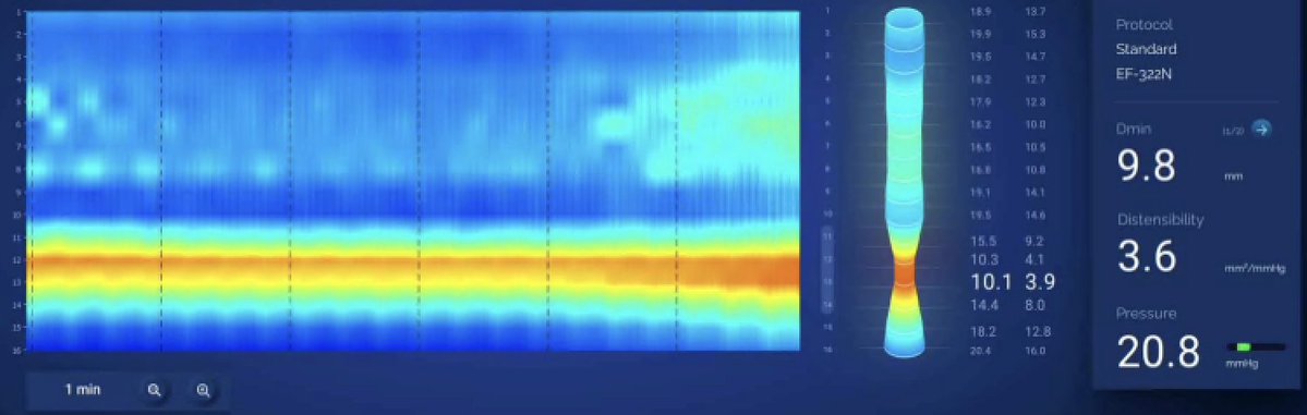 Tom Tielleman, MD (@tomtielleman) on Twitter photo So amazing to see in real time the effects of POEM using <a href="/MedtronicGI/">MedtronicGI</a>'s Endoflip. This was a Type 3 Achalasia with known 14 cm hyper contractile segment on manometry. You can see the drastic difference on same day Endoflips before and after myotomy. So amazing to see in real time the effects of POEM using <a href="/MedtronicGI/">MedtronicGI</a>'s Endoflip. This was a Type 3 Achalasia with known 14 cm hyper contractile segment on manometry. You can see the drastic difference on same day Endoflips before and after myotomy.