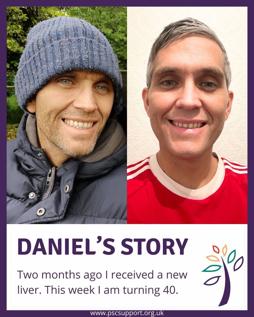 Two months ago Daniel received a life saving liver transplant. This week he turns 40 🎉 with a new lease on life. Happy birthday Daniel and many thanks for sharing your story. 
➡️ buff.ly/Pnkavam #LetsBeatPSC #OrganDonation <a href="/NHSOrganDonor/">NHS Organ Donation 💗🫀🫁</a> <a href="/LeedsHospitals/">Leeds Teaching Hospitals</a>