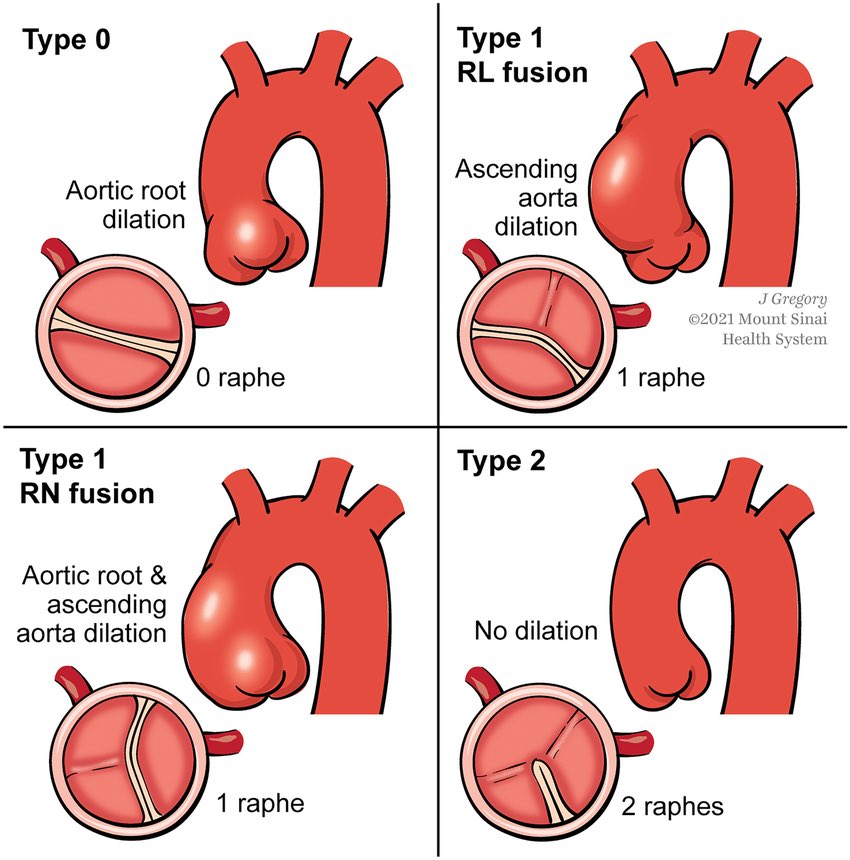 1/8
How often should patients with a bicuspid aortic valve (BAV) be monitored?
Let’s break down the latest guidelines to help prevent complications like aortic dilation, aneurysm, or dissection